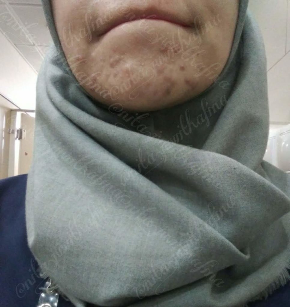 Akibat salah skincare Akibat salah skincare