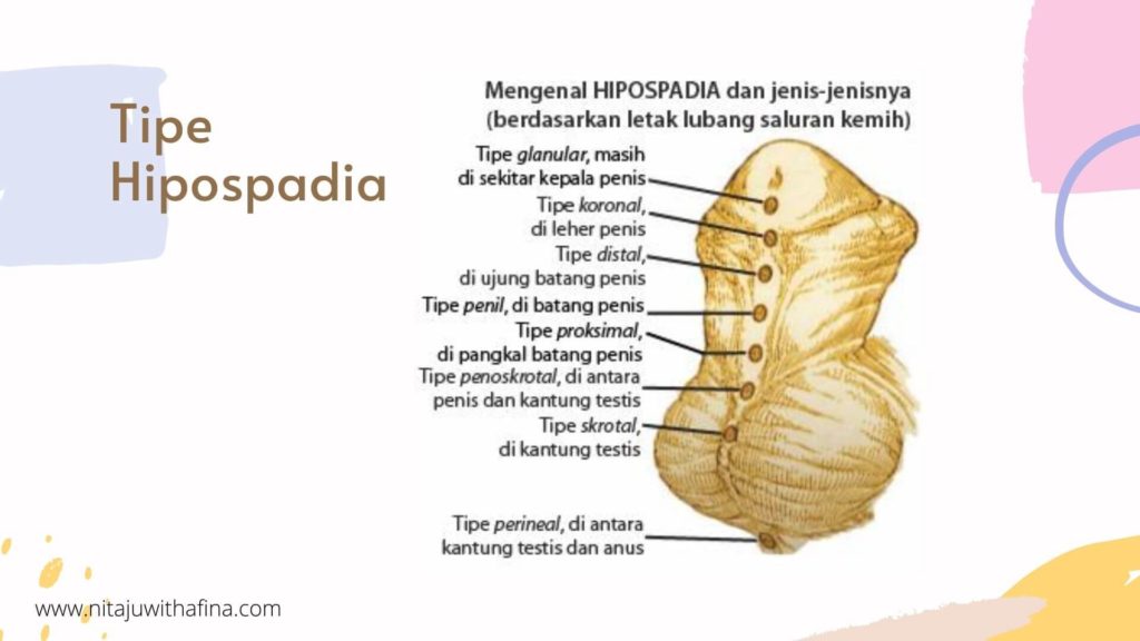 Berikut tipe-tipe hipospadia Tipe Hipospadia Pada Anak