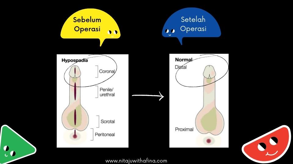 Cerita sebelum dan sesudah operasi hipospadia