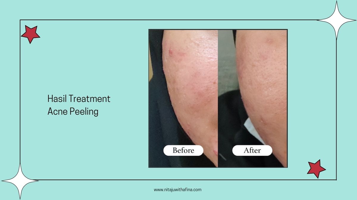 Before After Erha Acne Center