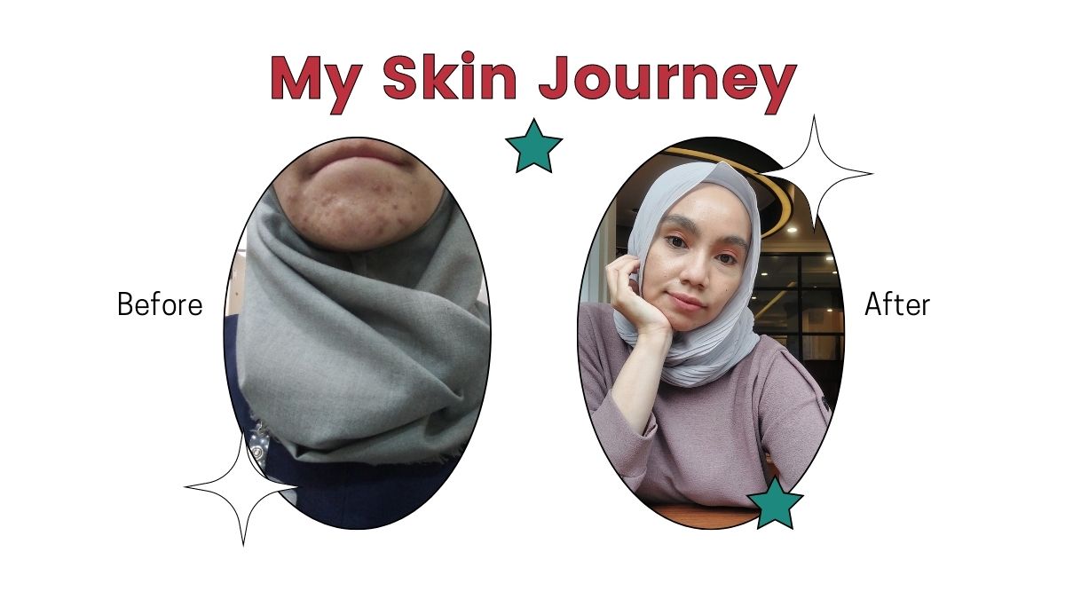My Skin Journey